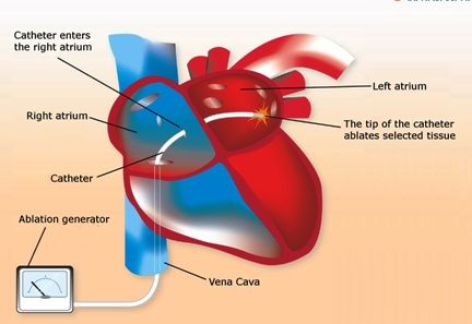 atrial fibrill cardiac_catheter_ablation